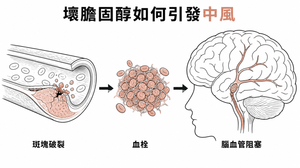 壞膽固醇斑塊破裂形成血栓阻塞腦血管導致缺血性中風