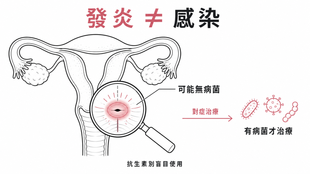 抹片發炎不等於感染,很多是找不到病菌的無菌性發炎不需抗生素,只有披衣菌淋病滴蟲疱疹等病菌引起時才對症治療