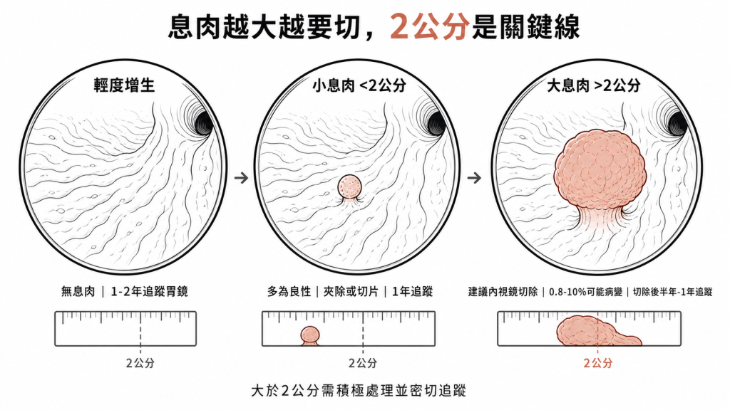 胃鏡視野下息肉分級:輕度增生無息肉1到2年追蹤、小息肉小於2公分多為良性夾除或切片1年追蹤、大息肉大於2公分有0.8到10%病變機率建議內視鏡切除並半年到1年密切追蹤
