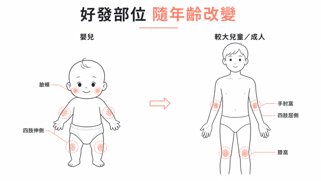 異位性皮膚炎好發部位隨年齡改變：嬰兒臉頰與四肢伸側、較大兒童與成人四肢屈側手肘窩膝窩