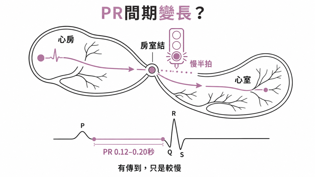 心臟電流從心房經房室結傳到心室，一度房室傳導阻滯就是這段傳遞變慢的示意圖