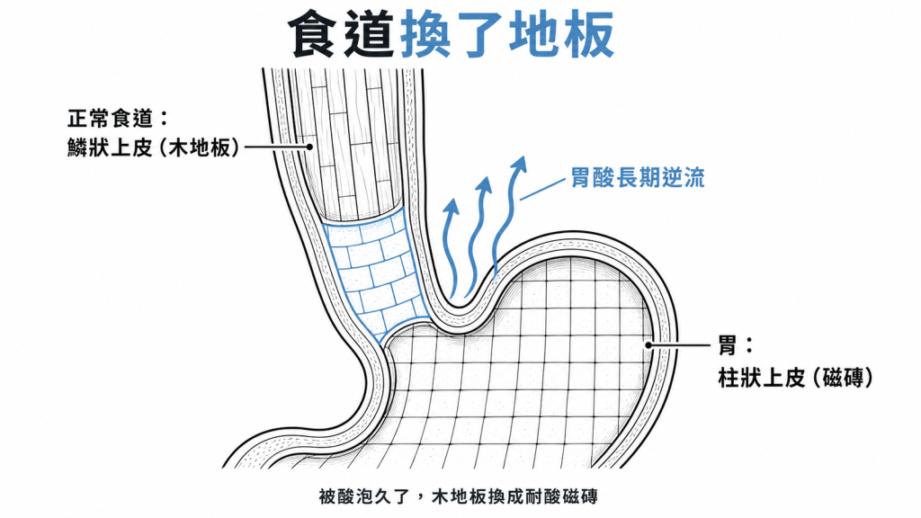 巴瑞特食道像食道換地板：胃酸長期逆流把食道下段的木地板鱗狀上皮換成耐酸磁磚柱狀上皮