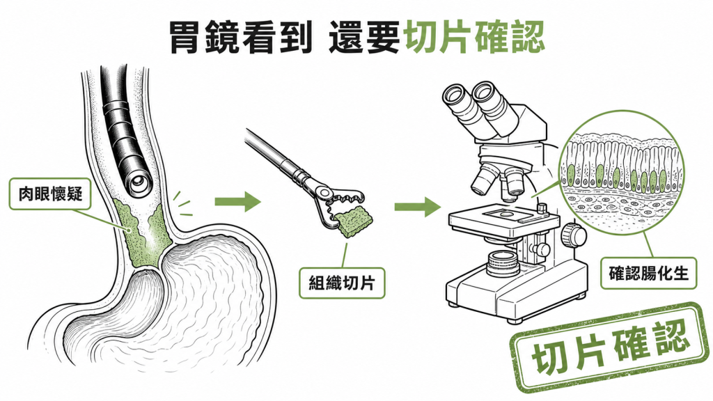 巴瑞特氏食道需胃鏡切片確認腸化生才能確診