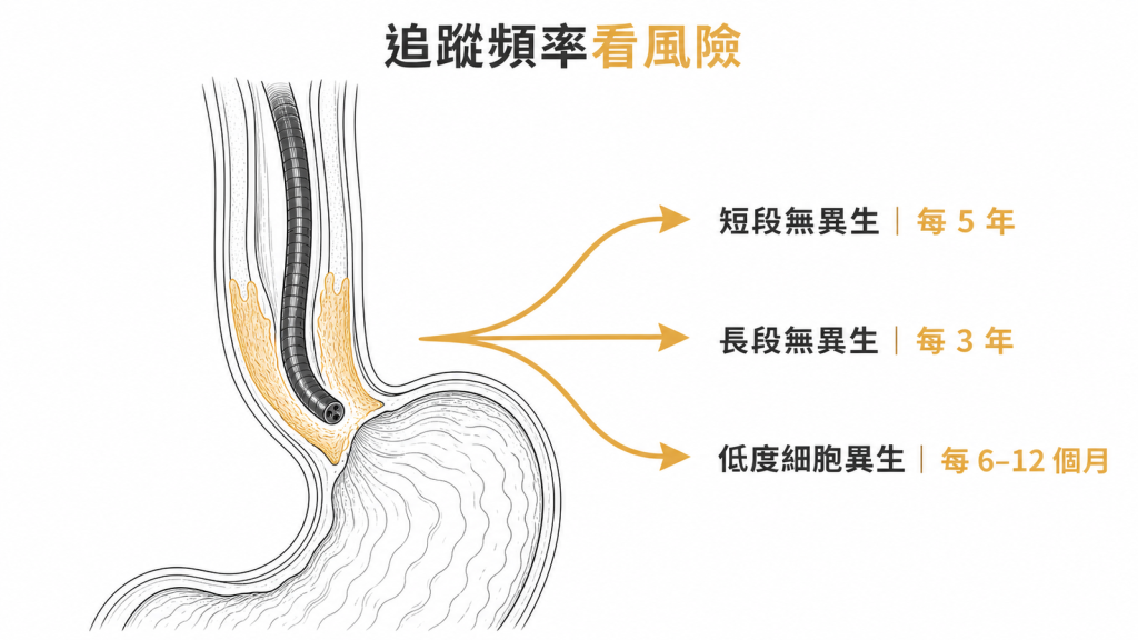 巴瑞特氏食道依病變長度與細胞異生安排追蹤