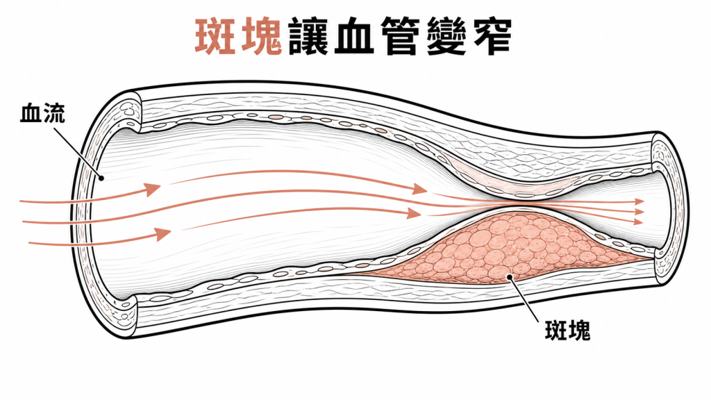 冠狀動脈斑塊使血管通道變窄