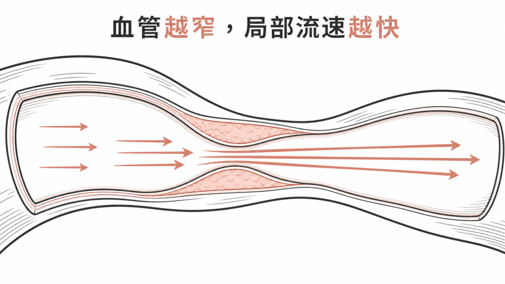 頸動脈狹窄會使局部血流速度加快