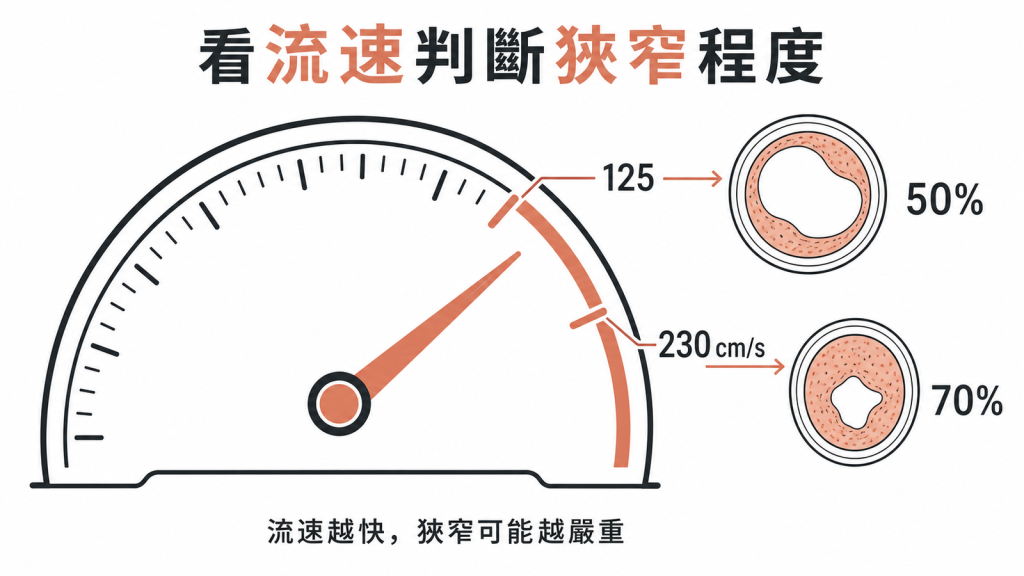 頸動脈 PSV 超過 125 與 230 cm/s 對應不同狹窄警訊