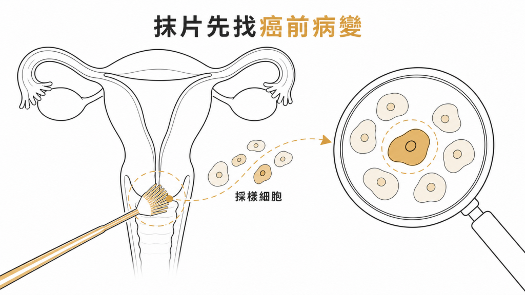 子宮頸抹片採樣可先找出癌前病變