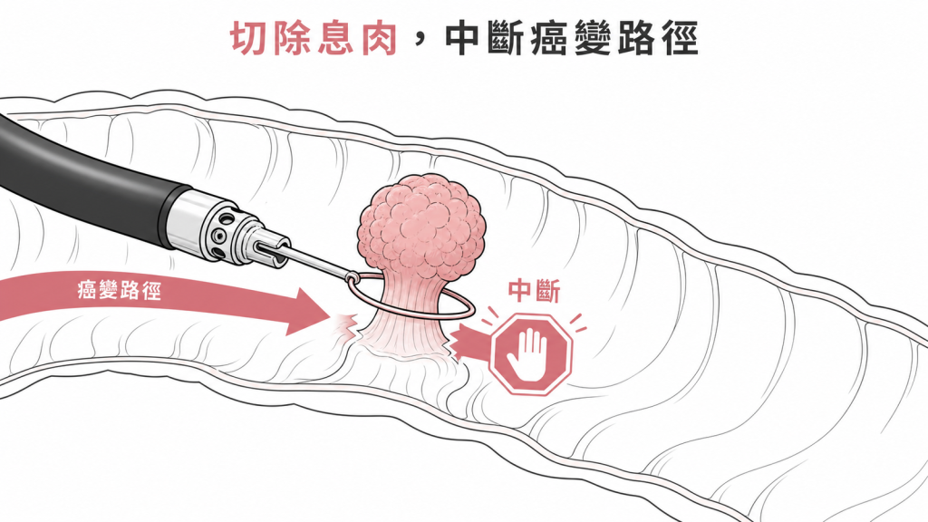 大腸息肉可能沿途演變為癌症線稿圖