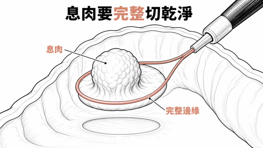 息肉切除必須完整乾淨