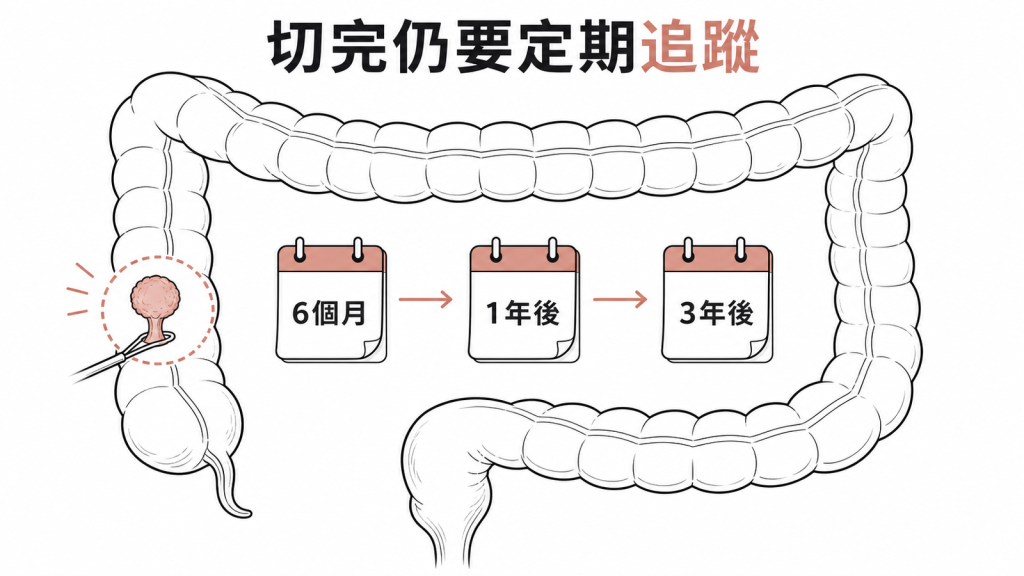 大型息肉切除後需定期複查
