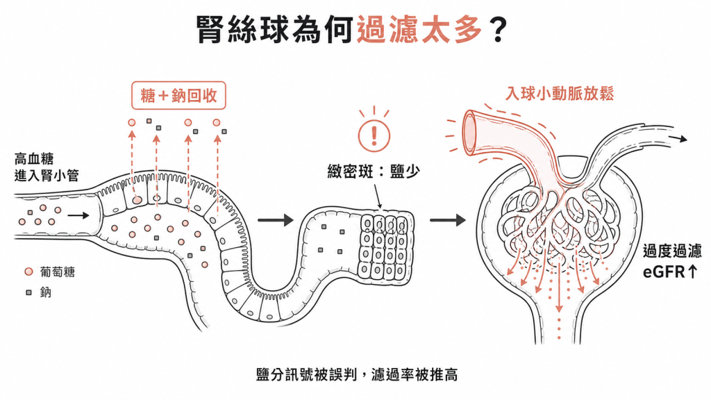 糖尿病腎小管過度回收糖與鈉，緻密斑偵測到鹽變少誤判，入球小動脈放鬆導致過度過濾 eGFR 升高