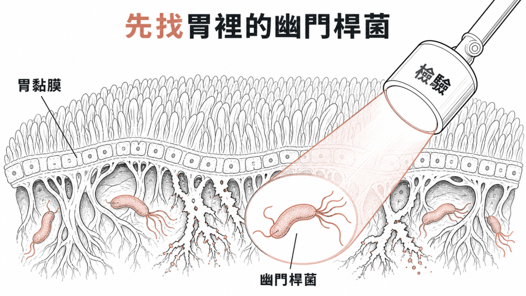幽門桿菌會持續傷害胃黏膜