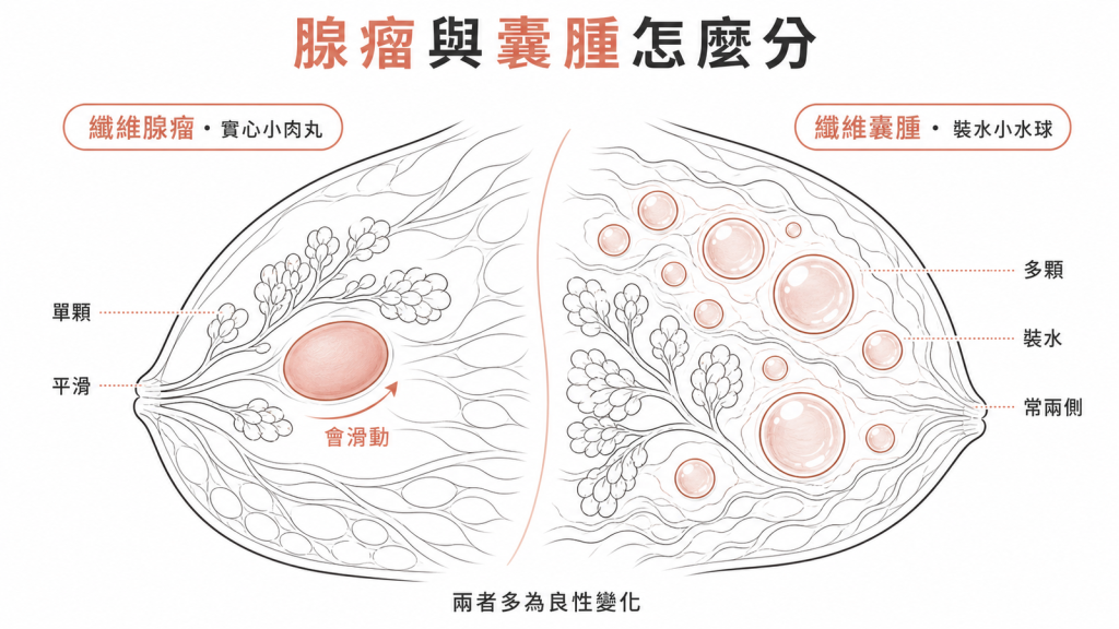纖維腺瘤是平滑會滑動的單顆實心小肉丸,纖維囊腫是多顆散佈的裝水小水球,兩者多為良性