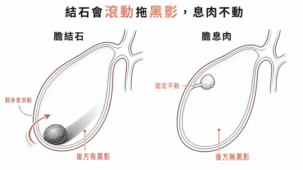 膽結石會隨翻身滾動且後方拖黑影,膽息肉固定不動且後方無黑影