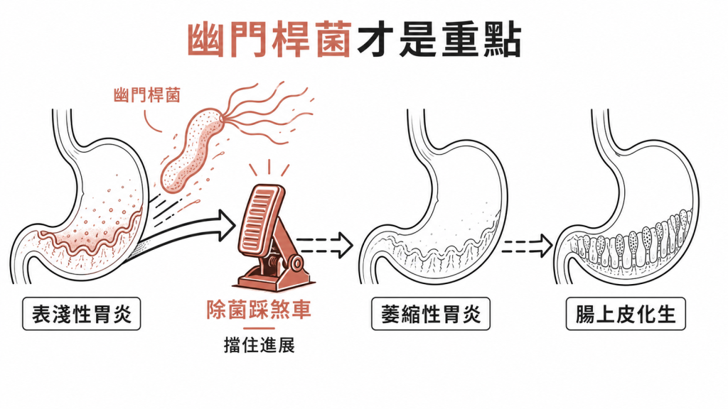 幽門桿菌才是重點：它推動胃炎從表淺性往萎縮性、腸上皮化生進展，除菌等於踩煞車擋住進展