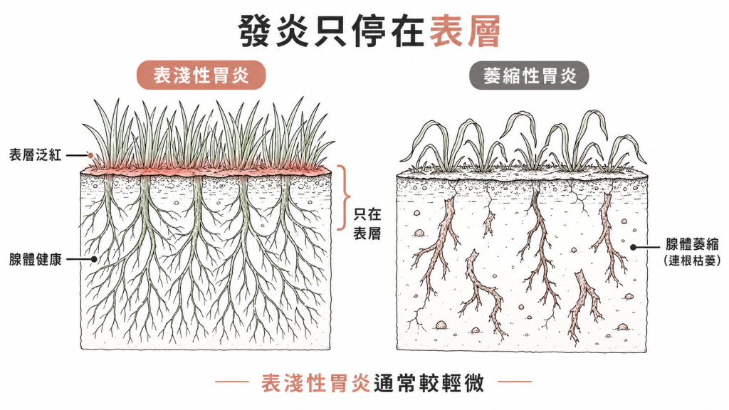 表淺性胃炎像草皮表層泛紅但根系健康，發炎只停在表層，比連根枯萎的萎縮性胃炎輕微