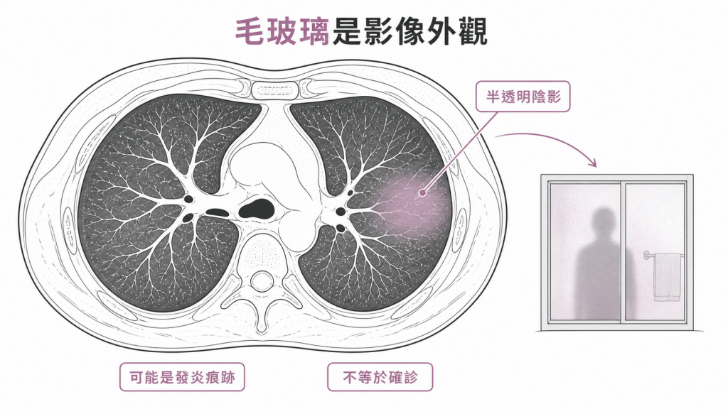 毛玻璃結節是肺部半透明影像外觀,不等於確診