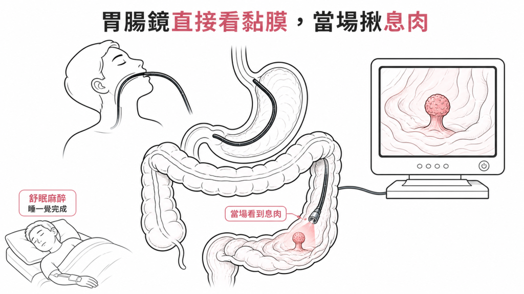 舒眠麻醉下胃腸鏡直接看黏膜，當場發現並切除息肉