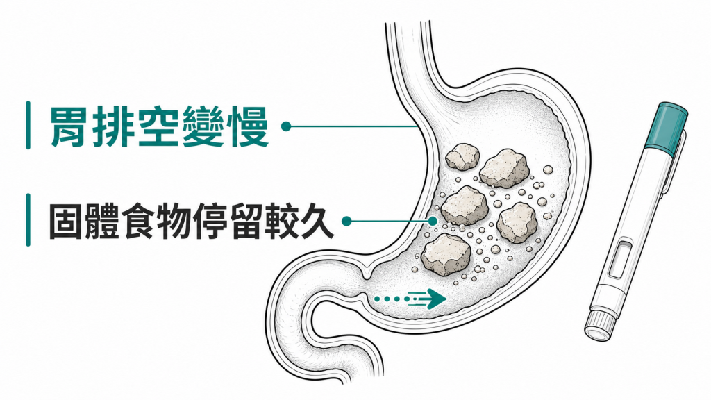 GLP-1 可能讓胃排空變慢,使固體食物在胃中停留較久
