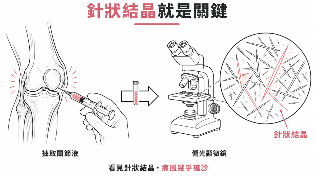 抽關節液後在偏光顯微鏡下看到尿酸鈉針狀結晶,痛風診斷幾乎確定