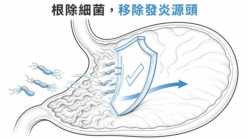 根除幽門螺旋桿菌降低胃部長期傷害線稿圖