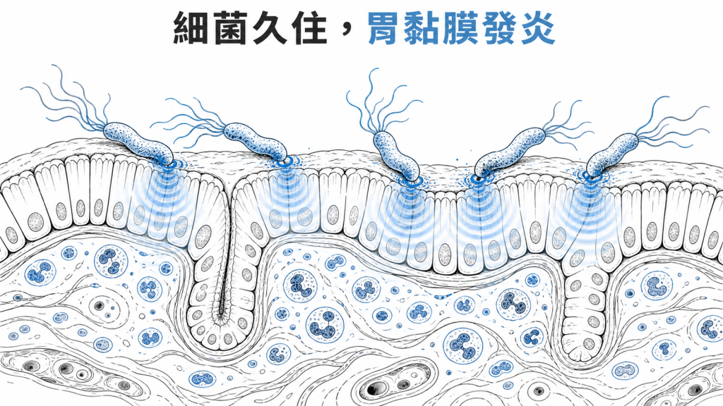 幽門螺旋桿菌附著胃黏膜造成慢性發炎線稿圖