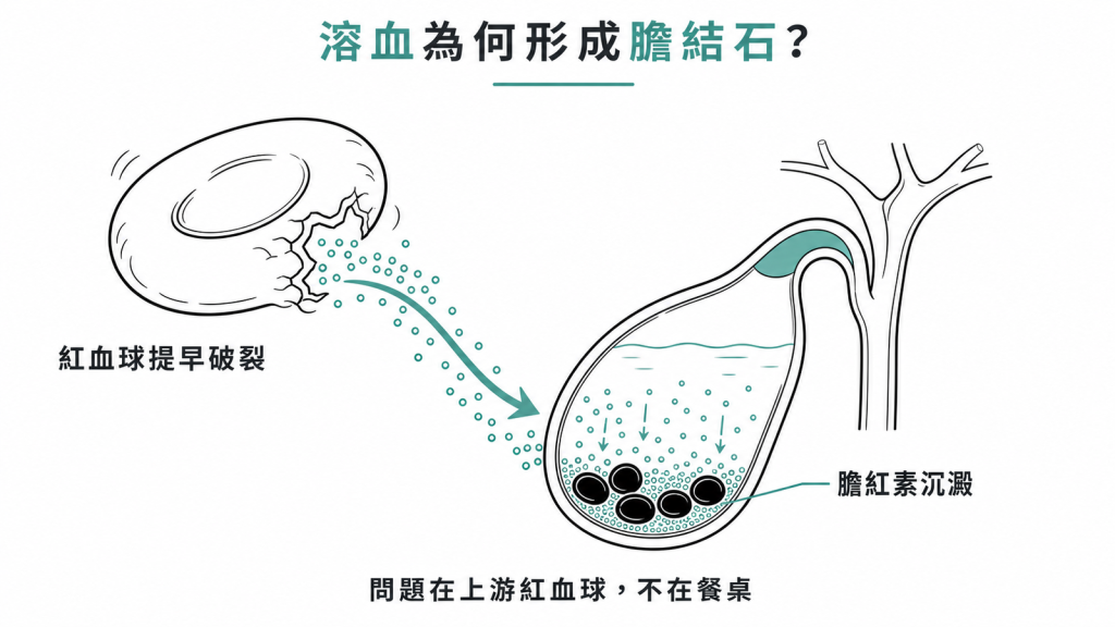 紅血球提早破裂釋出膽紅素，在膽囊沉澱形成黑色色素結石