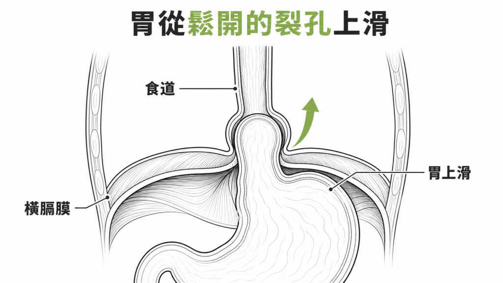 食道裂孔鬆弛讓胃向胸腔滑動