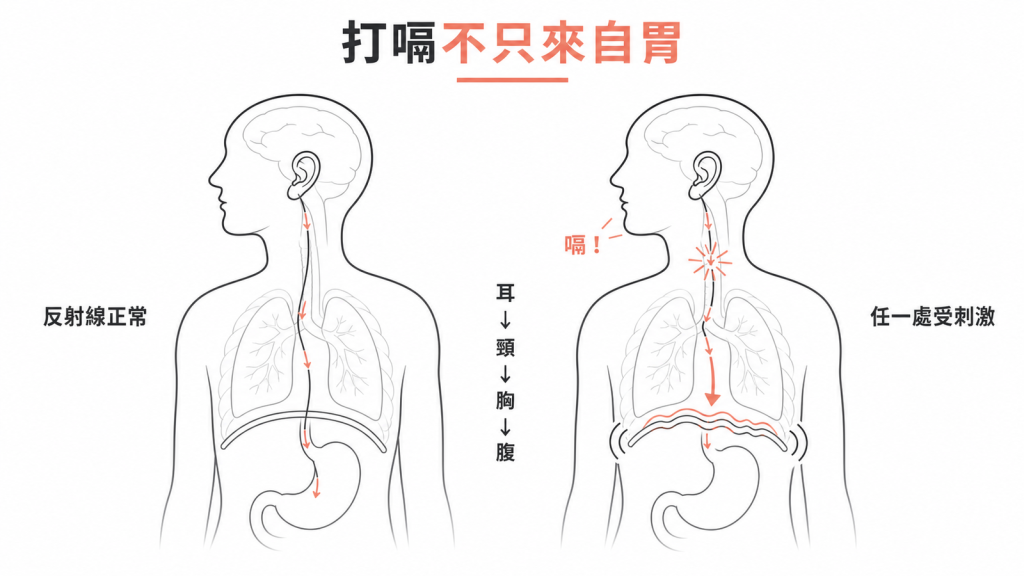打嗝反射線從耳朵經頸部胸腔到腹部,任一處受刺激都可能引發打嗝