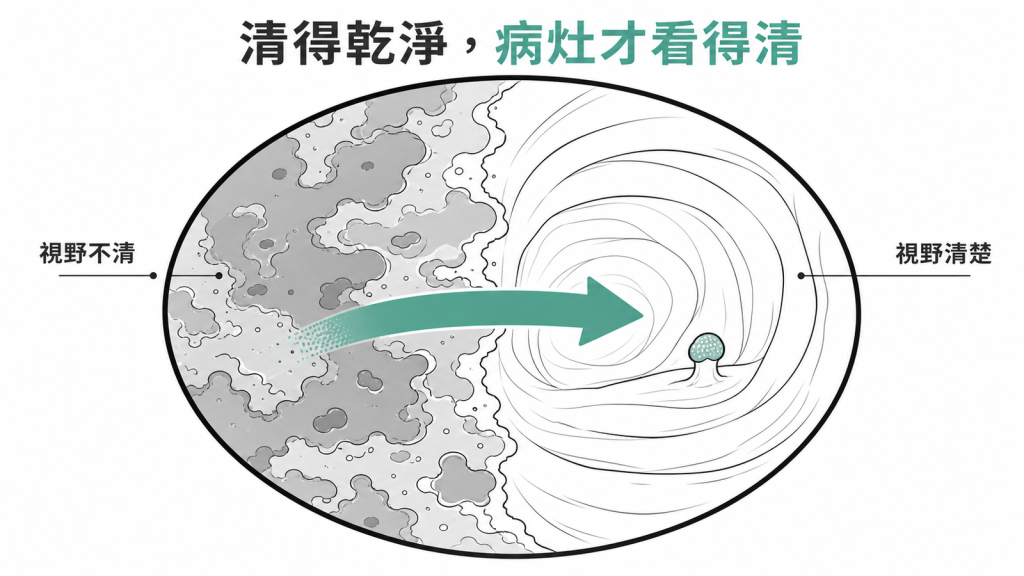 腸道準備乾淨,醫師才看得清楚病灶