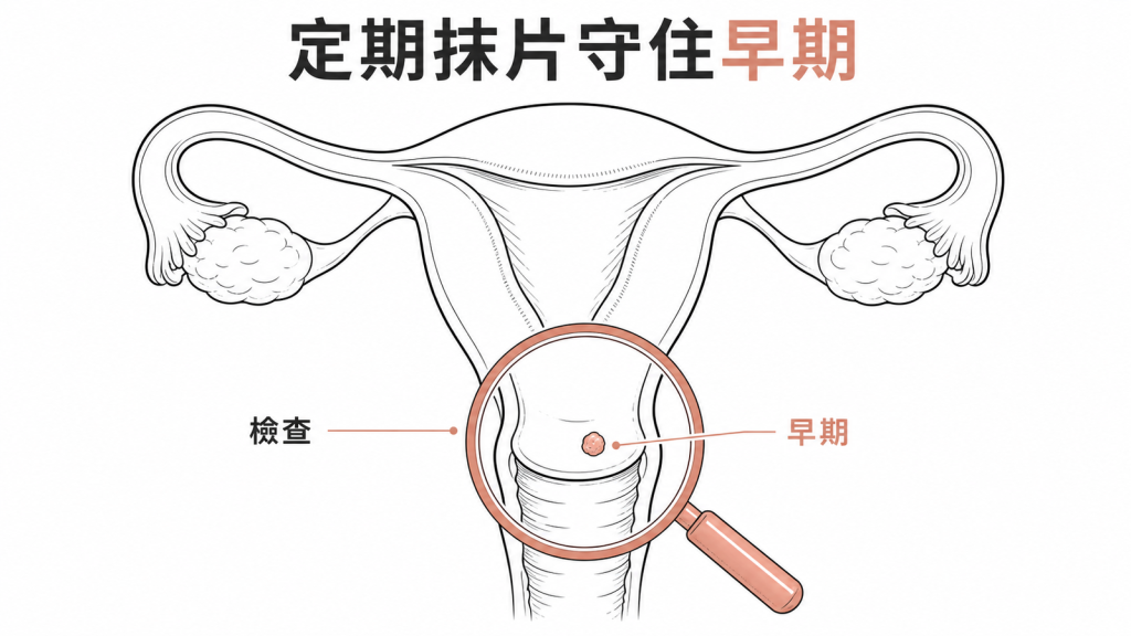 子宮頸篩檢及早發現示意