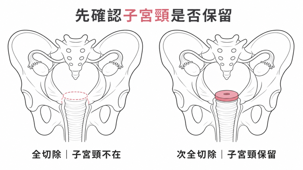 全子宮切除與次全切除是否保留子宮頸示意圖