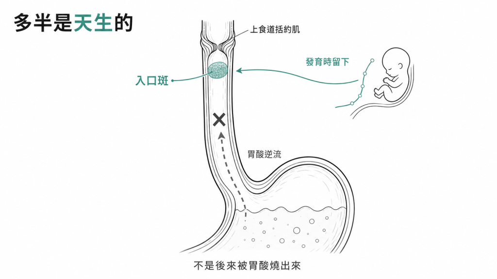 入口斑多半是天生的:位於上食道括約肌下方,胚胎發育時留下,不是被胃酸逆流燒出來