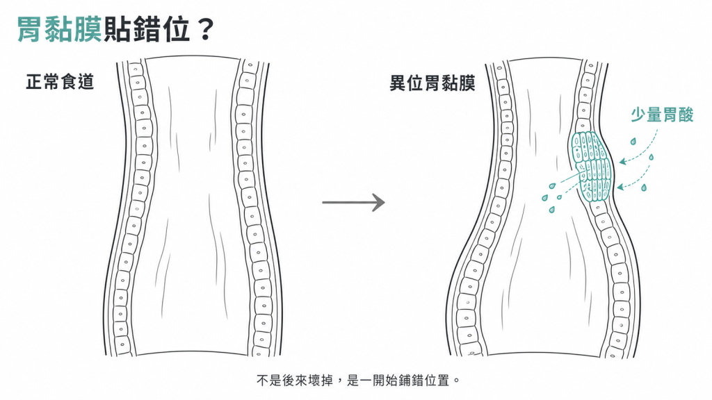 正常食道與異位胃黏膜對照:胃黏膜像貼錯位置,會分泌少量胃酸