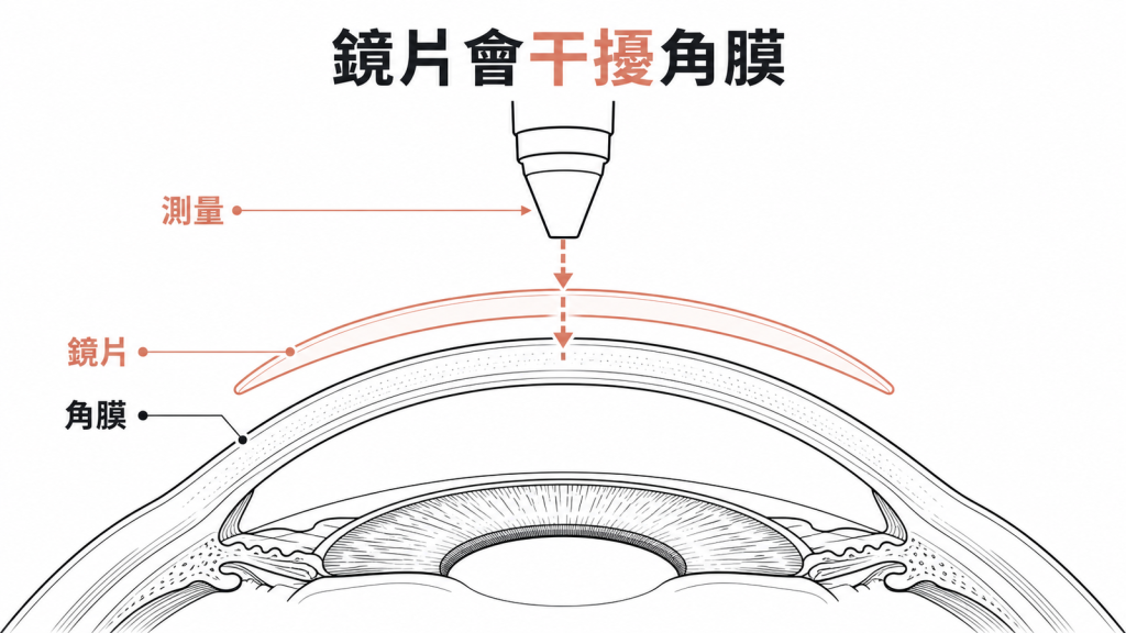 鏡片干擾角膜受力示意