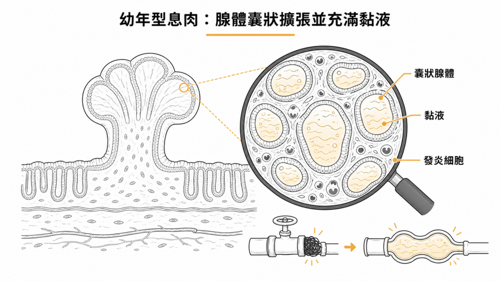 幼年型息肉囊狀腺體充滿黏液的病理示意圖