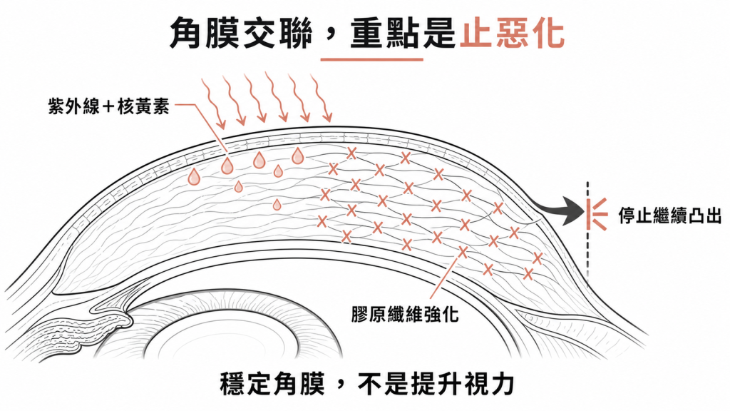 角膜交聯術用紫外線與核黃素強化膠原纖維,目的是阻止角膜繼續凸出