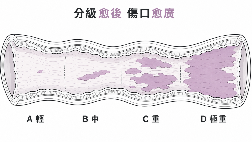 洛杉磯分級由A到D反映食道黏膜受傷範圍