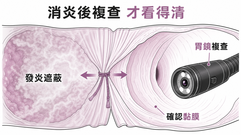 嚴重食道炎治療後需胃鏡複查確認黏膜與病變