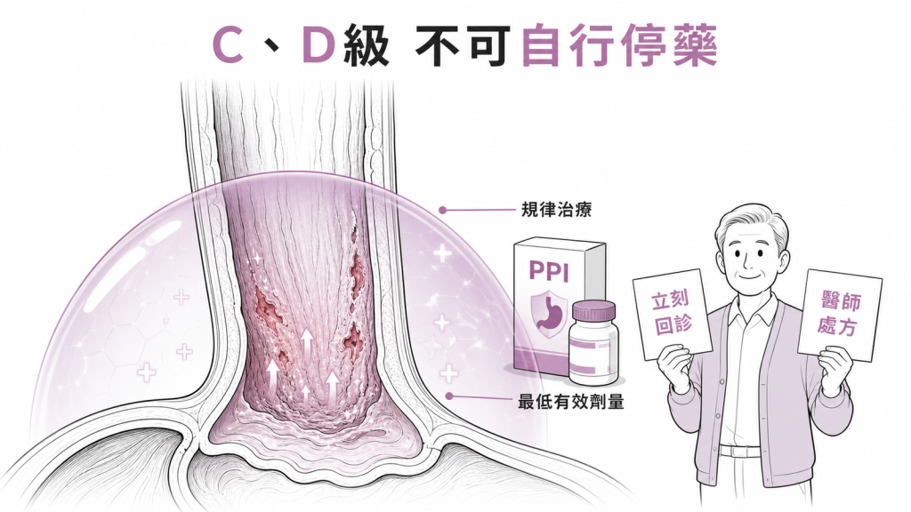 C與D級食道炎需規律治療不可自行停藥