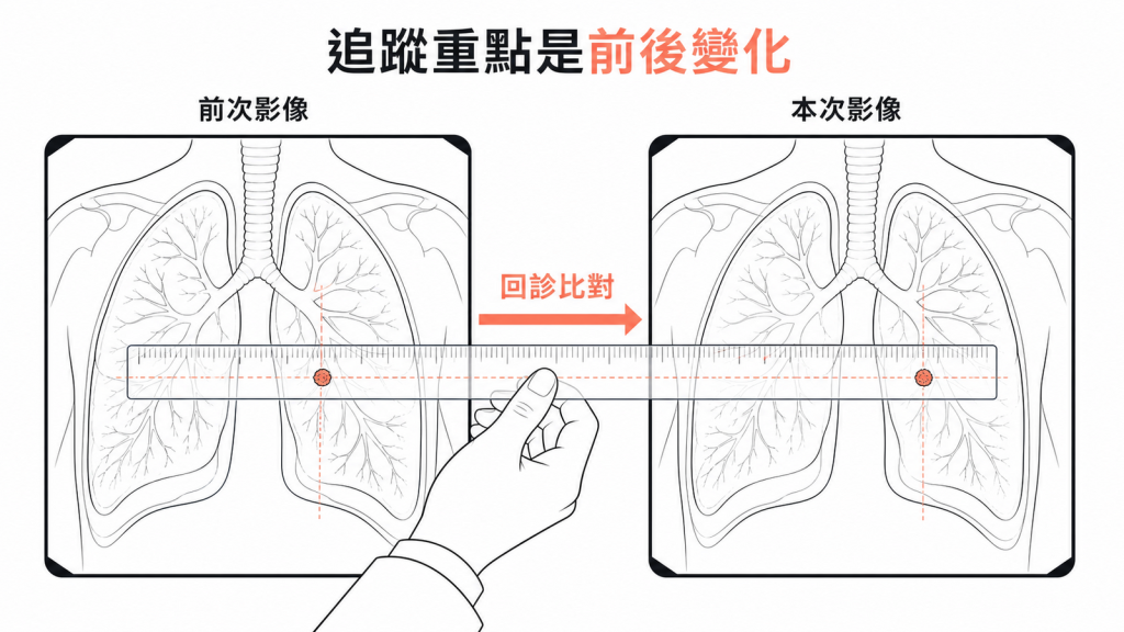 肺結節追蹤重點是前後影像變化