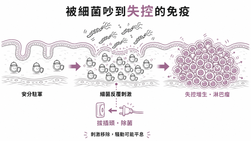 幽門桿菌長期刺激讓胃黏膜免疫B細胞增生失控成MALT淋巴瘤，拔掉插頭除菌後騷動可能平息