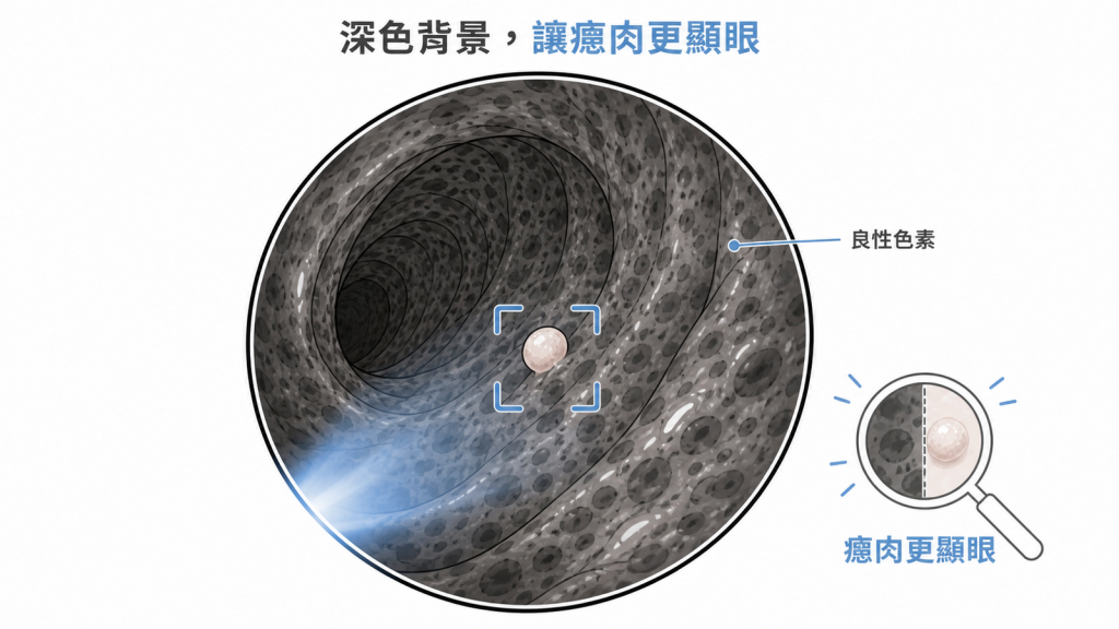 大腸黑變病深色背景讓淺色瘜肉更顯眼示意圖
