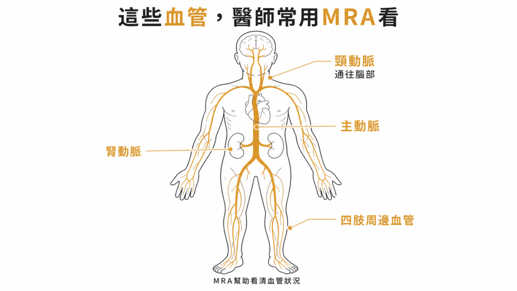 醫師常用MRA檢查的血管包括通往腦部的頸動脈主動脈腎動脈與四肢周邊血管找出狹窄阻塞剝離與動脈瘤