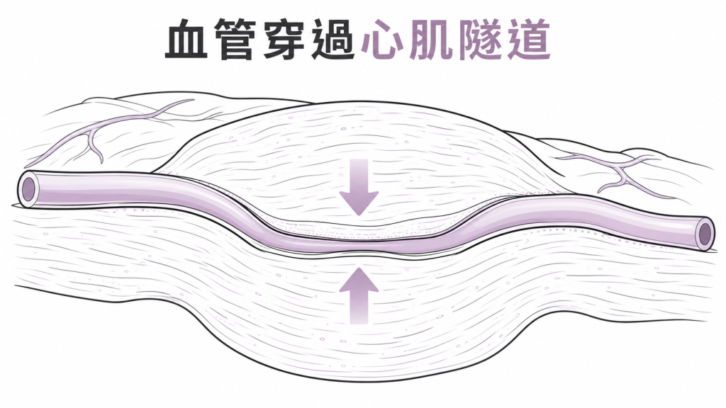 心肌橋在心臟收縮時壓迫冠狀動脈線稿圖
