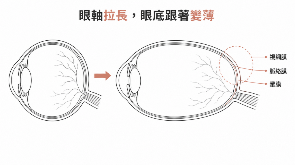 眼軸拉長會讓視網膜、脈絡膜與鞏膜一起被拉薄