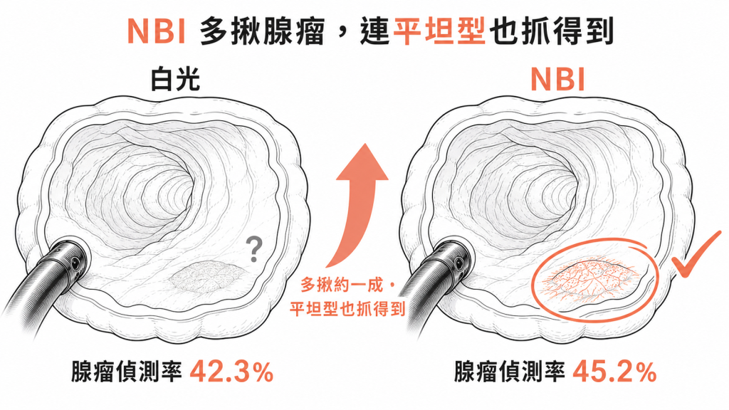 NBI大腸腺瘤偵測率45.2百分比高於白光42.3百分比連平坦型瘜肉也抓得到