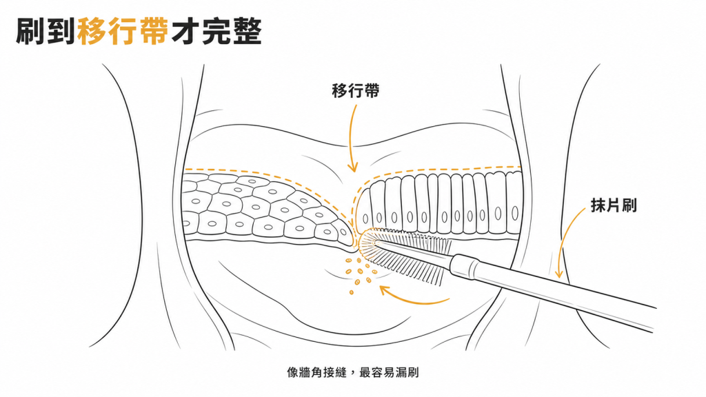 子宮頸移行帶採檢示意圖:抹片刷刷過鱗狀與柱狀上皮交界帶下內頸細胞