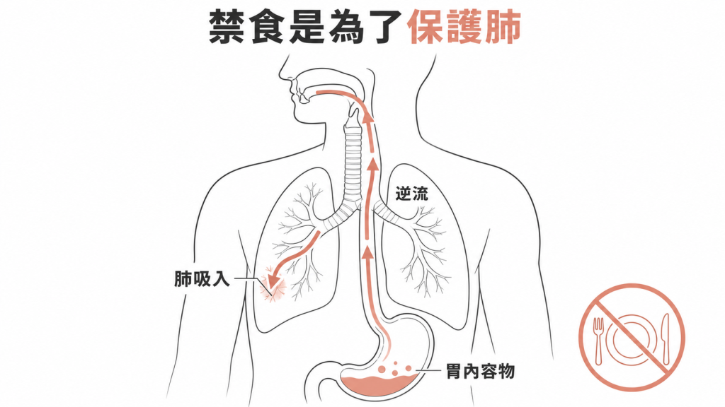 麻醉禁食可降低胃內容物逆流造成肺吸入的風險